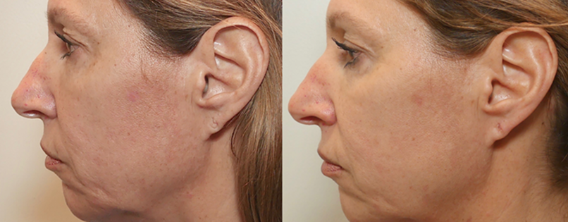 6cdf983e-m8facetite-bforley-faceneck-56fem-1_10mr0e60mr09d00002e000.png